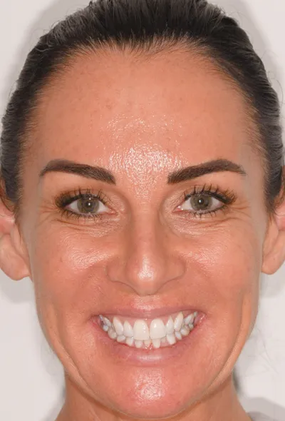 Jodies invialign aligners - Before