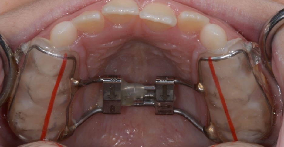 Does My Child Need an Expander?