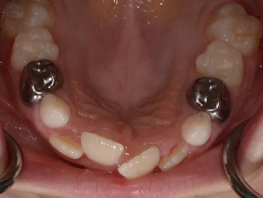 chalky-teeth-3