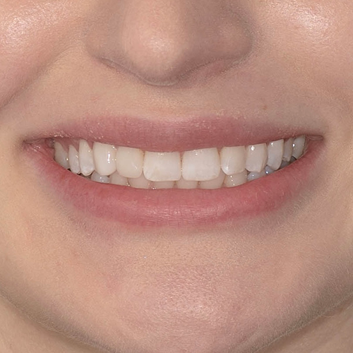 Composite bonding After