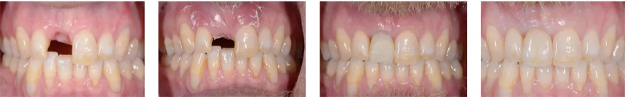 dental-implant-case-study