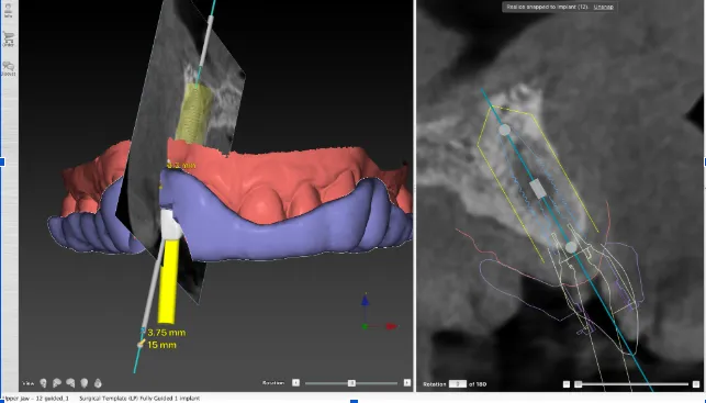 Dental Implant 3D Xray