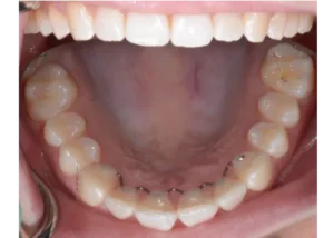 Invisalign wire retainer