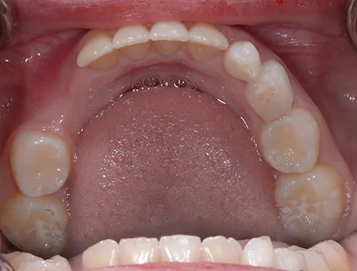 Orthodontics lower after correction
