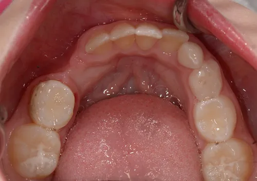 Orthodontics lower before correction