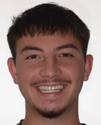 Nik Invisalign Procedure - After