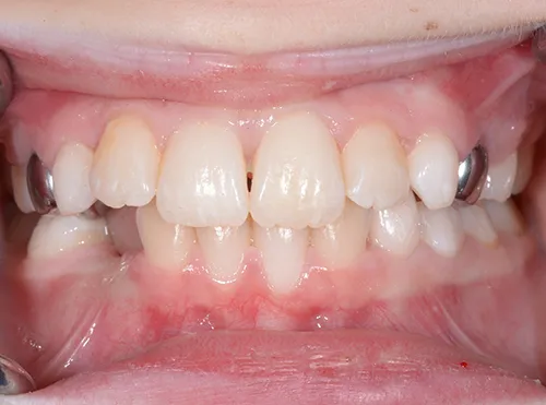 Orthodontics bite after correction
