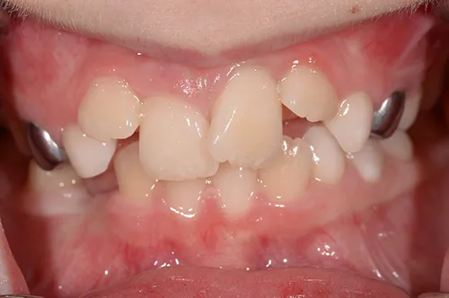 Orthodontics bite before correction