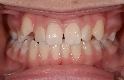 Orthodontics bite before