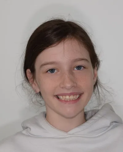 Ruby after invialign aligners