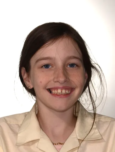 Ruby before invialign aligners