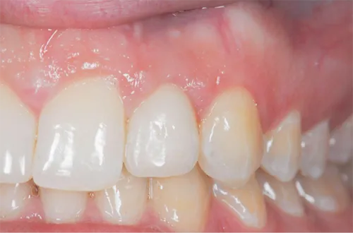 Single tooth implant after procedure