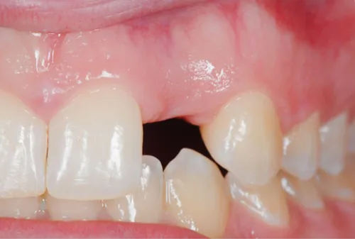 Single tooth implant befor procedure